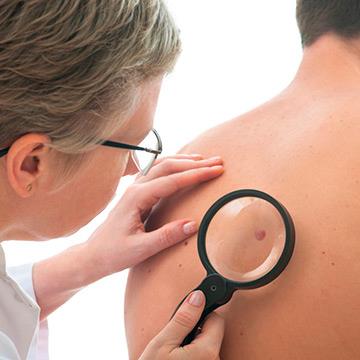 Quatro a cada cinco pessoas com melanoma são curadas
