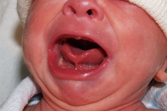 Obrigatório a partir de 2015, teste da linguinha já é feito em bebês de Brotas